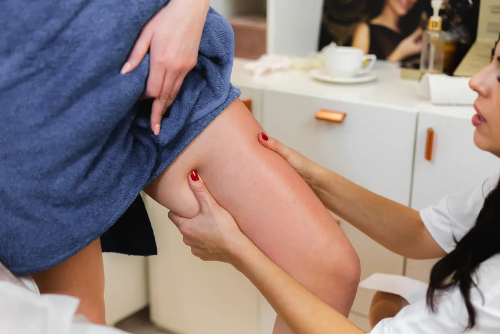 Spider Veins in Australia: Causes, Treatments and When to Seek Professional Advice