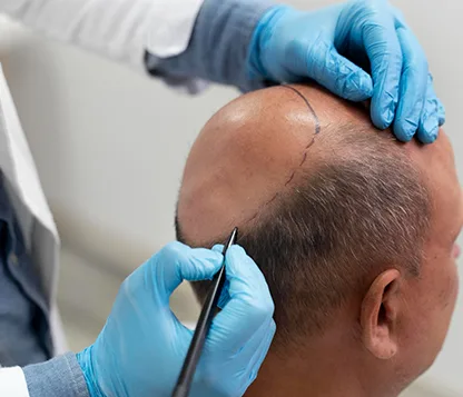 PRP for Hair Restoration: Permanent Results or Short-Term Gain?