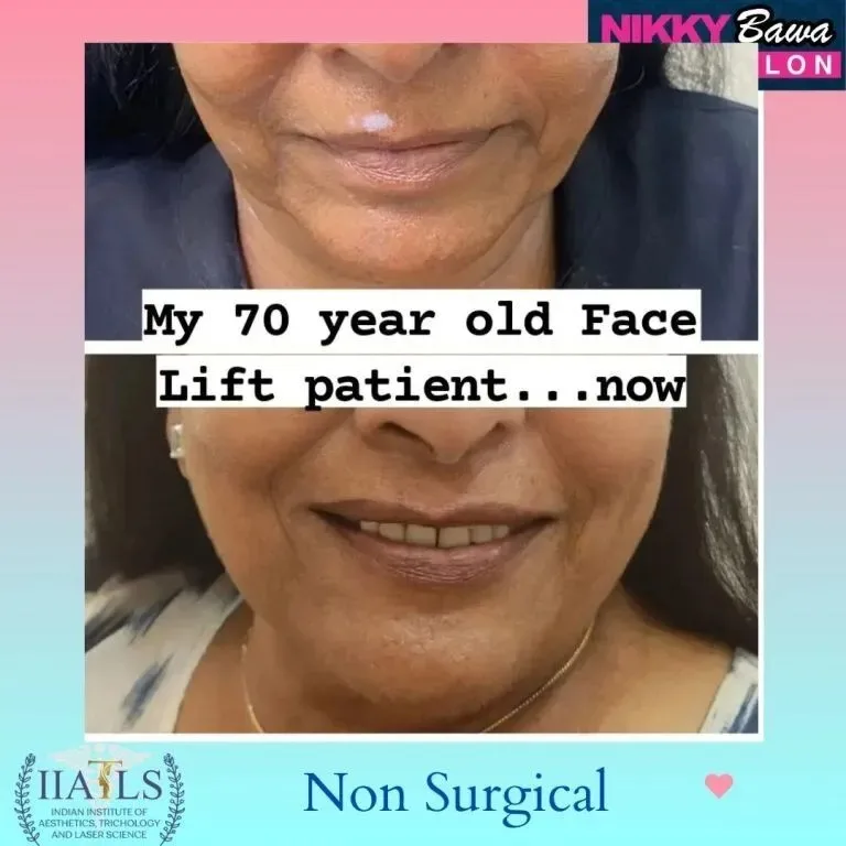 Why Face Slimming Treatment in Bhopal Is Trending at Aesthetic Salon Skin Clinics?