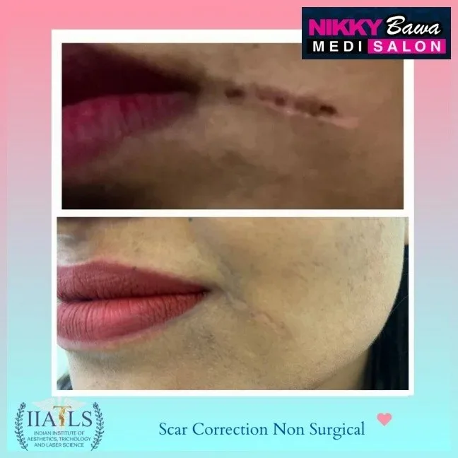 Why People Choose a Skin Care Clinic in Bhopal for Stretch Marks Treatment?