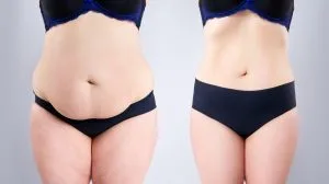 How Abdominoplasty Dubai Improves Core Strength