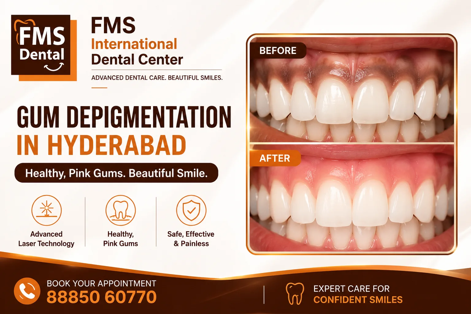 FMS International Dental Center Offers Advanced Gum Depigmentation in Hyderabad for Natural Smile Aesthetics