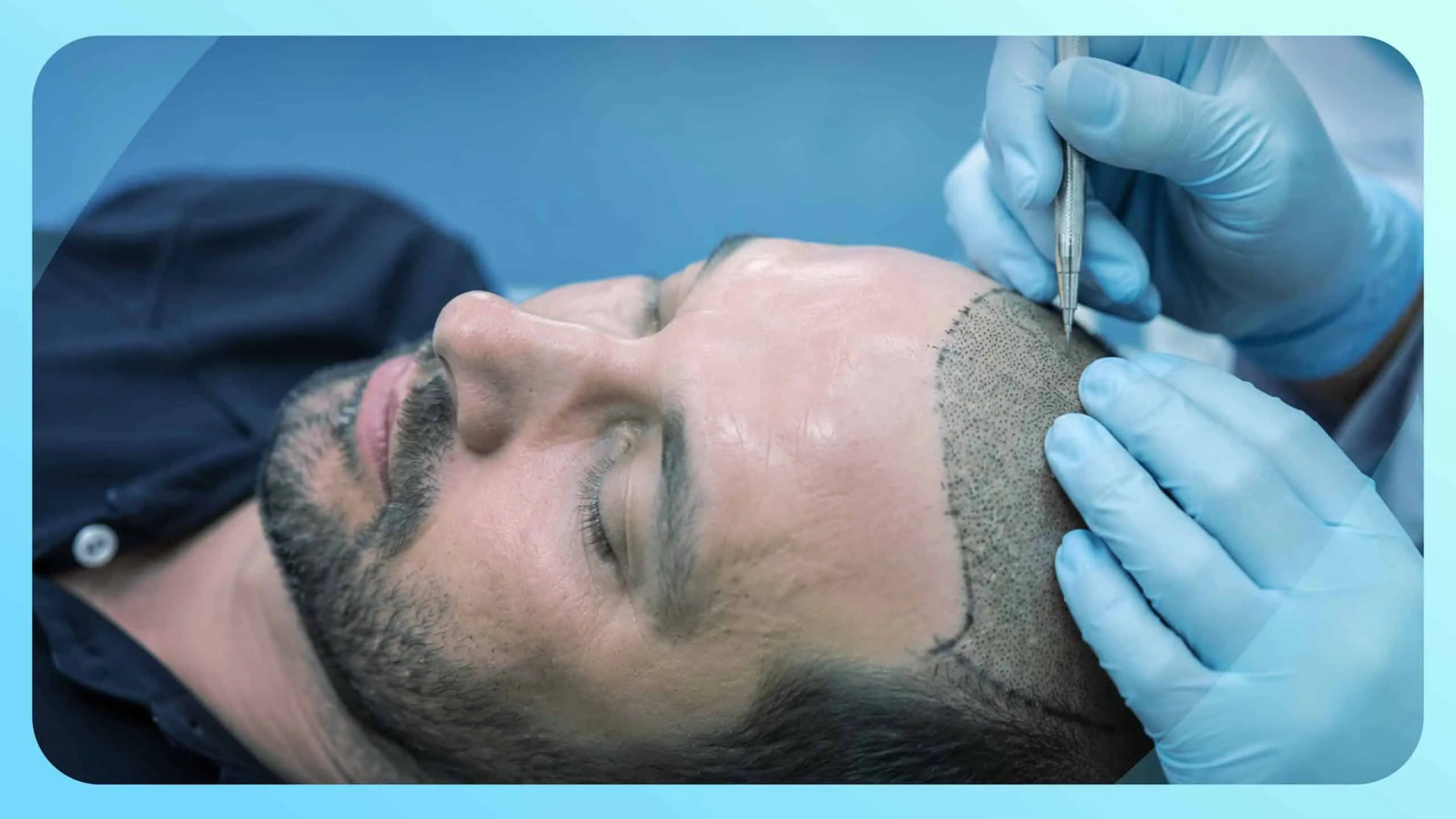 Don't Rush Into a Hair Transplant in Gurgaon: Know These Key Factors First