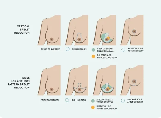 Breast Care Clinic Wakad for Expert Breast Cancer Consultation