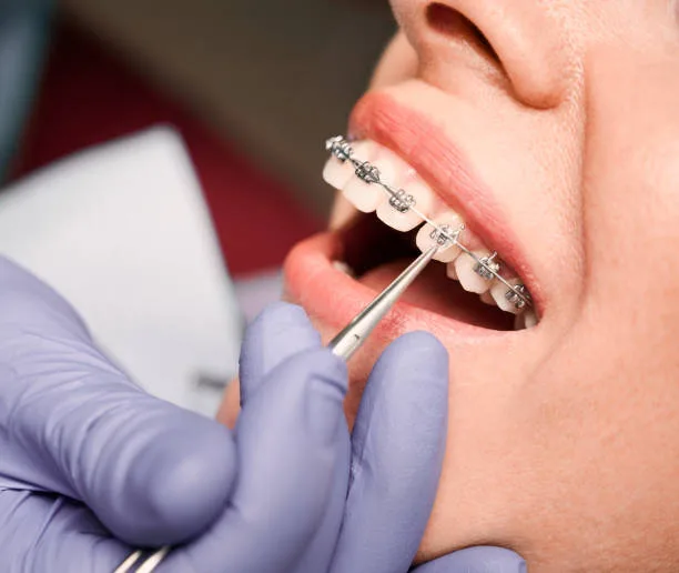 Why Professional Orthodontic Care Matters for a Healthier Smile