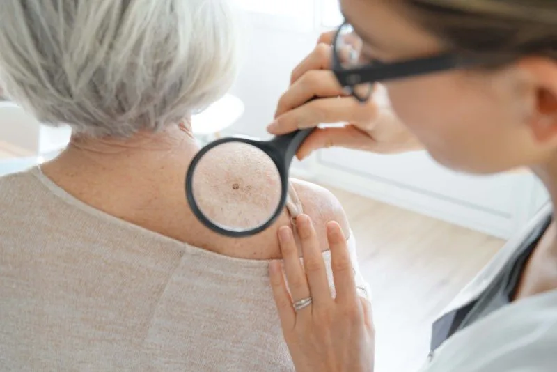 Choosing Mohs or SRT Skin Cancer Treatment in California