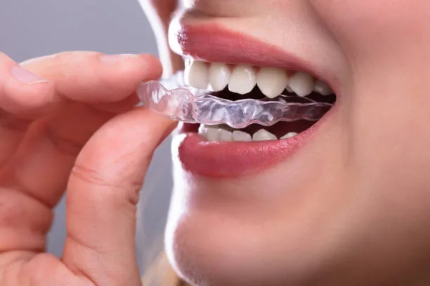A Smarter Way to Straighten Your Smile: What to Know About Clear Aligners in Mableton