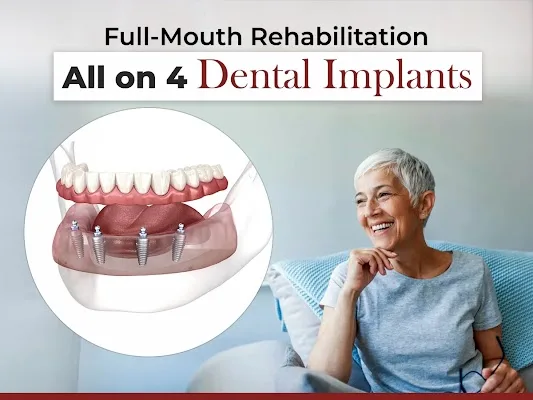 All-on-4 Dental Implants in Dilsukhnagar – A Modern Solution for Complete Smile Restoration
