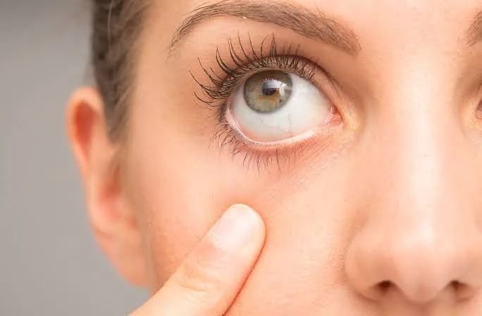 When Should I See an Optician for Dry Eyes?