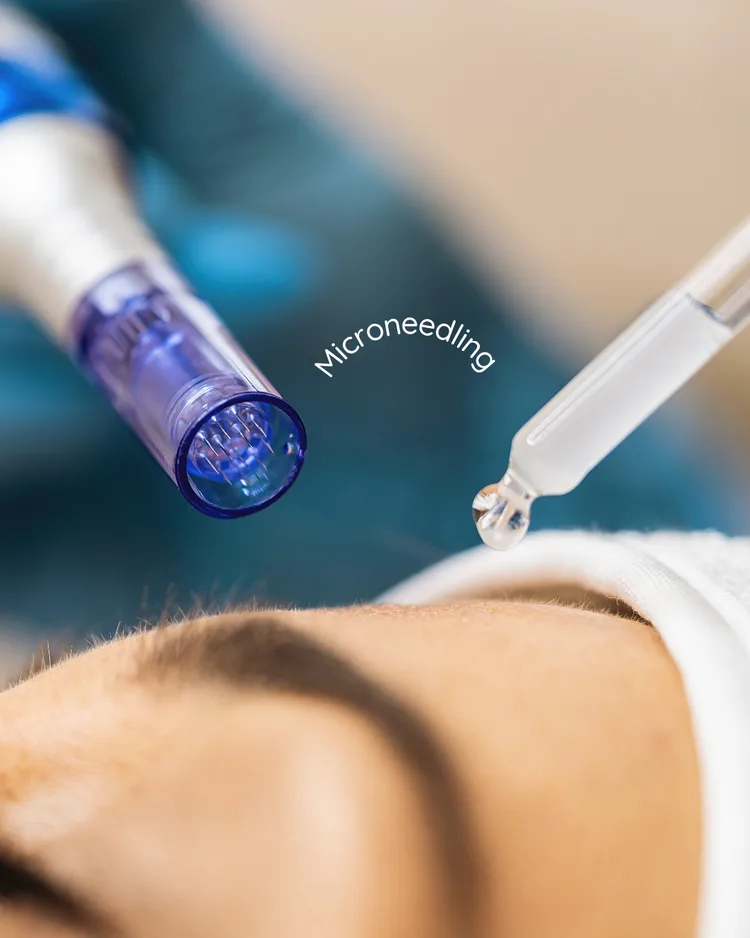 What is the difference between at-home microneedling and professional treatments?