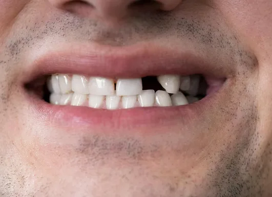 Missing Teeth: Understanding the Real Impact on Your Health
