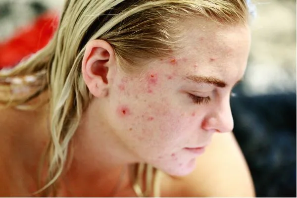 Laser Treatment for Acne Scars: What to Know Before Choosing a Treatment