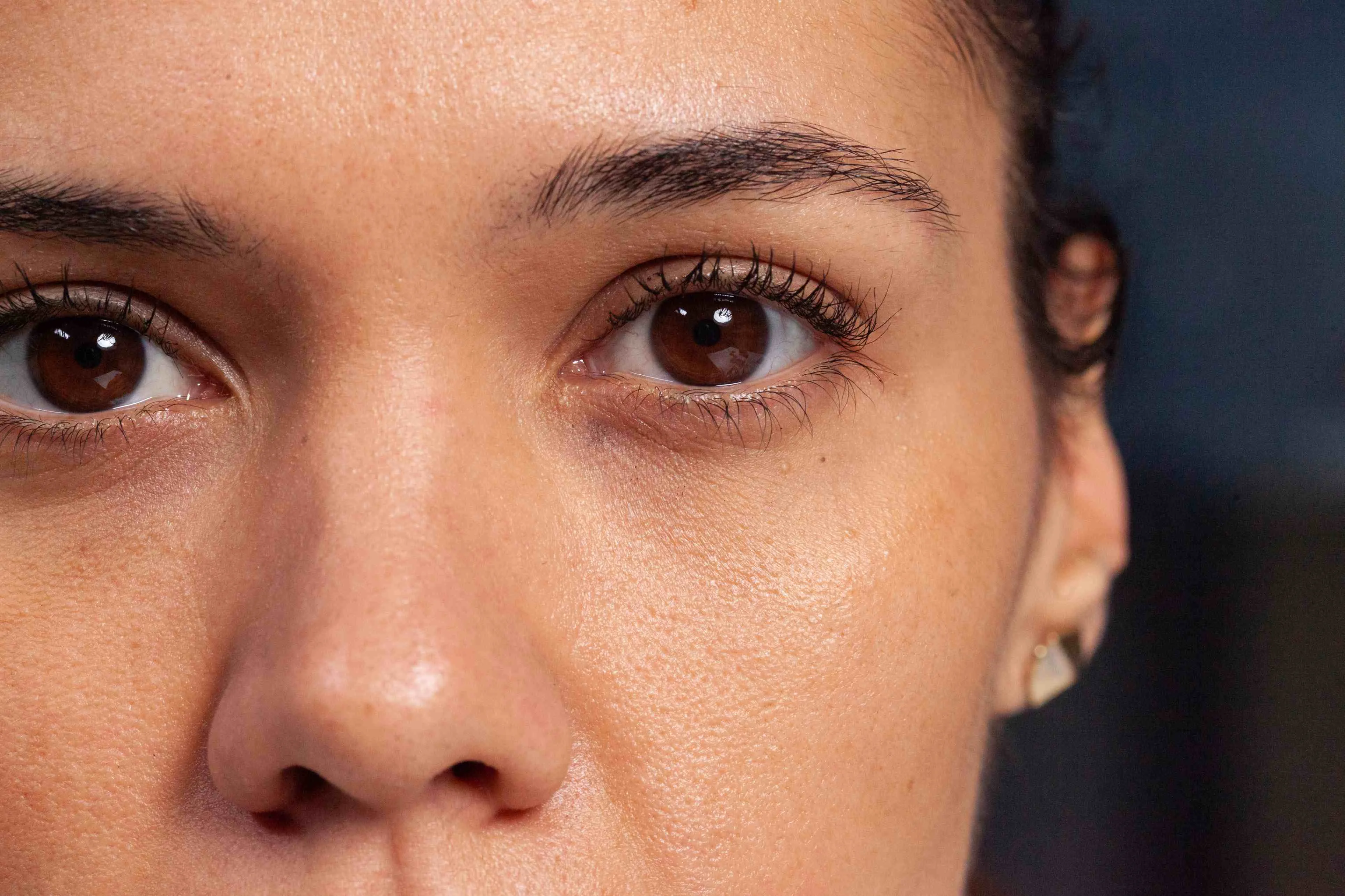 What Should a Skin Specialist Check Before Treating Your Dark Circles?