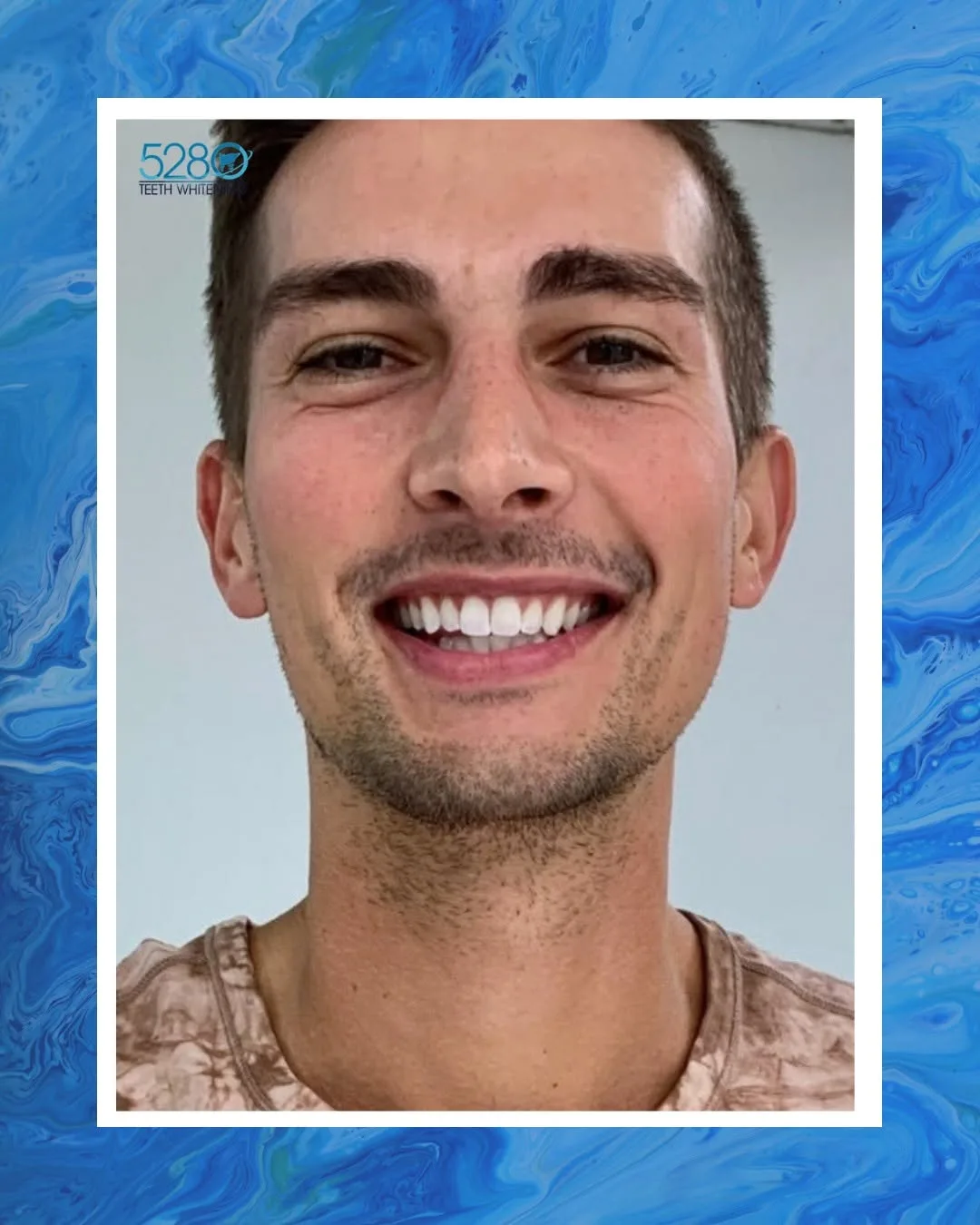 Professional Teeth Whitening Denver: Achieve a Brighter, More Confident Smile