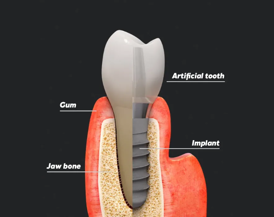 Restoring Structural Integrity: The Advanced Science and Lifelong Value of Modern Dental Implants