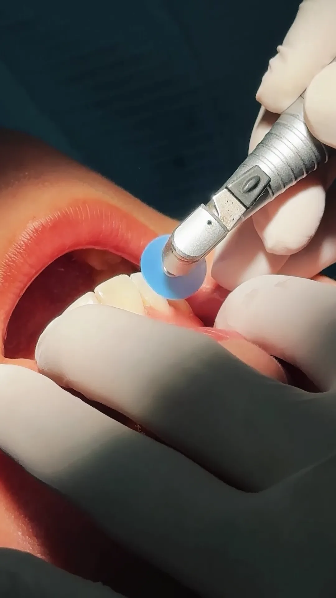 Advanced Clinical Insights into Teeth Scaling and Polishing by Experienced Dental Surgeons