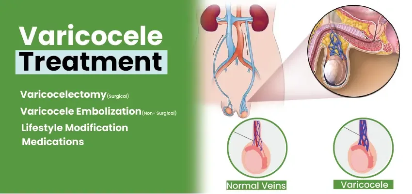 Varicocele and Its Treatments in Pakistan