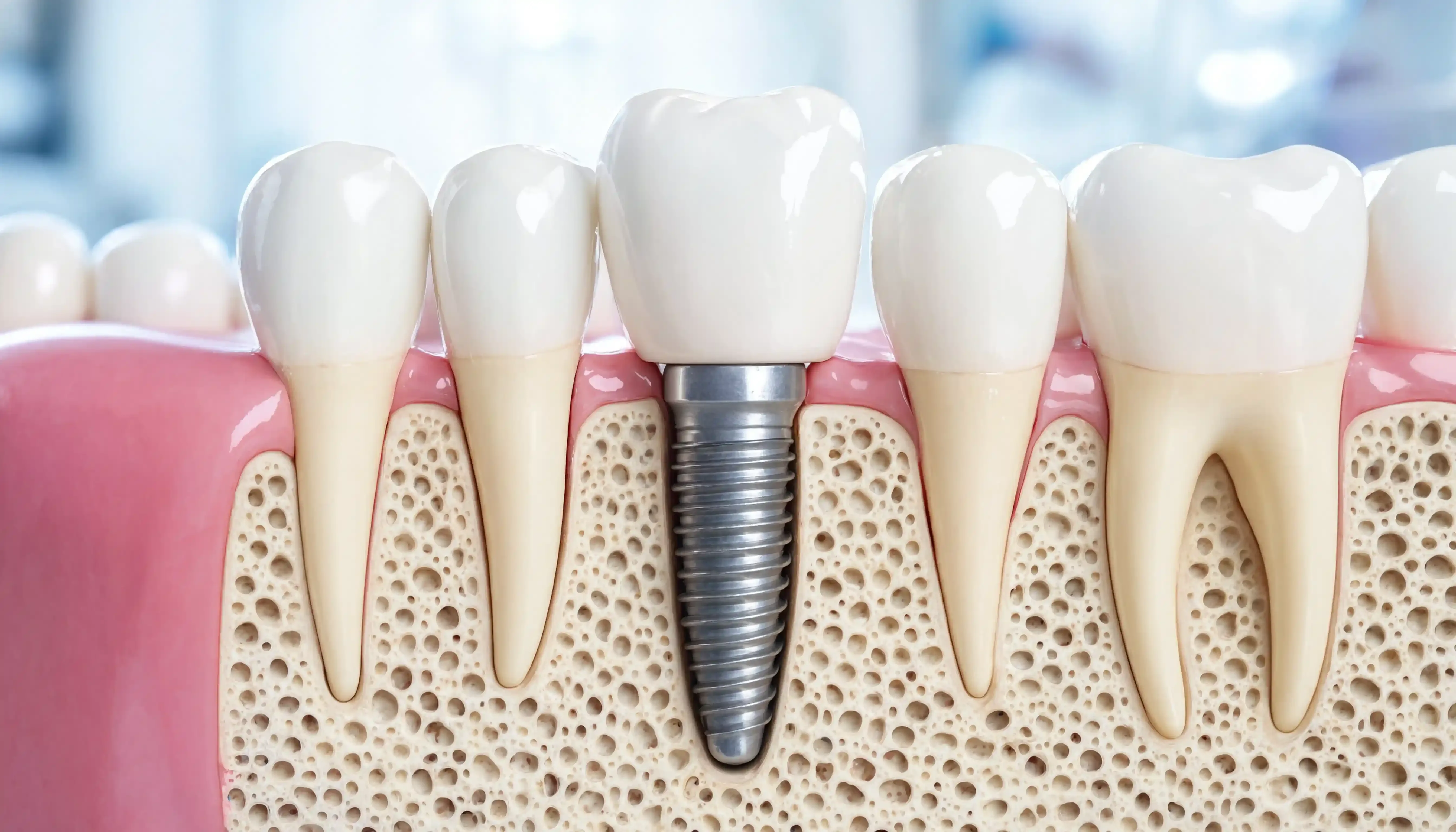 Dental Implants for Missing Teeth: Procedure, Benefits, Recovery and Aftercare