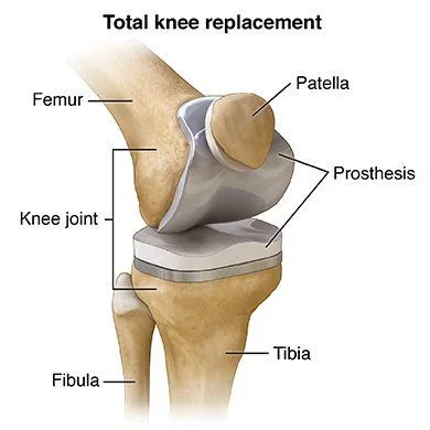 Total Knee Replacement: Benefits, Procedure, and Recovery Explained
