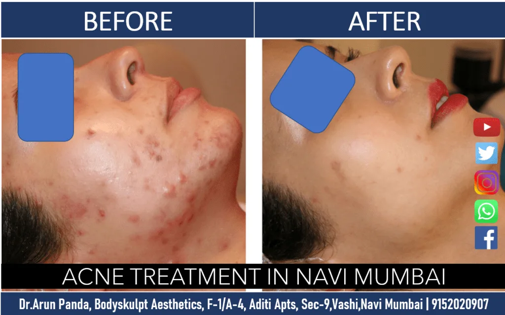 Cost of Acne Treatment in Navi Mumbai: What Every Patient Should Know Before Starting Treatment