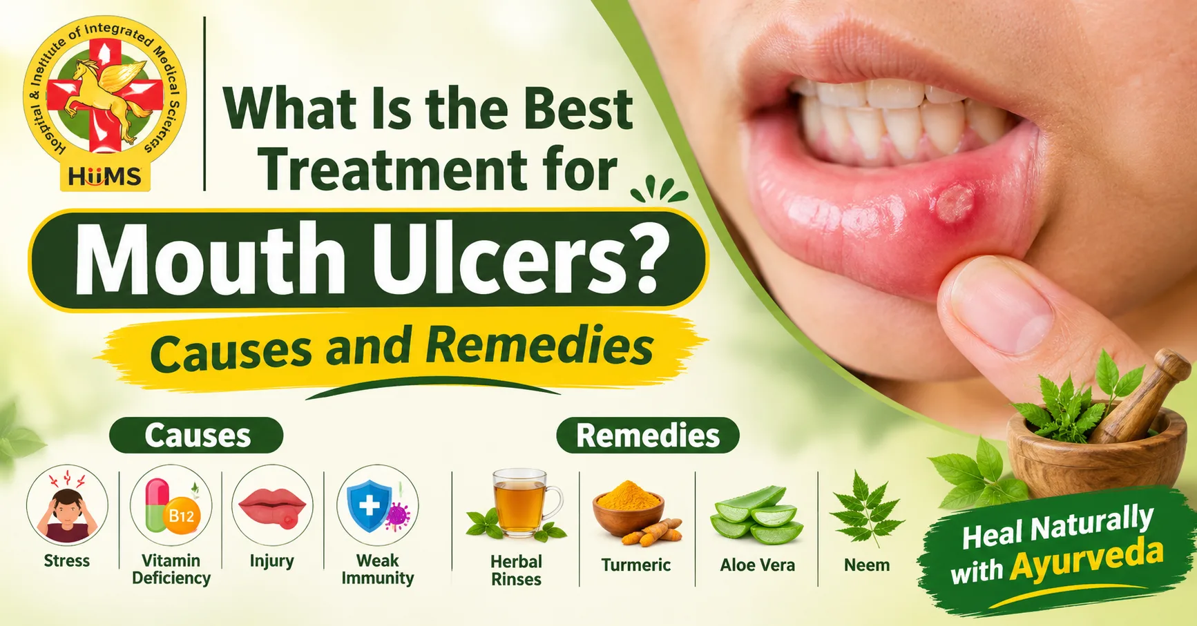 What Is the Best Treatment for Mouth Ulcers? Causes and Remedies