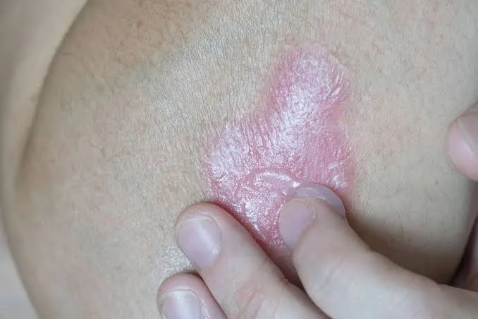 What Is the Best Psoriasis Treatment for Long-Term Relief?