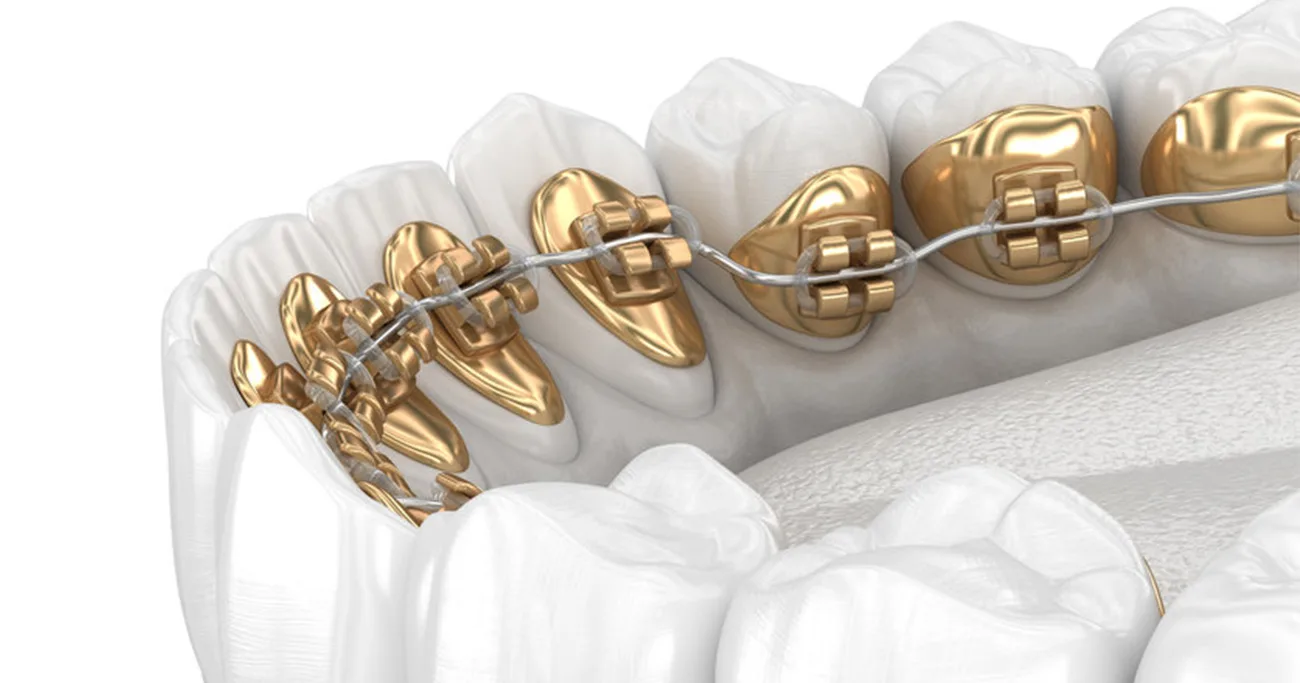 Why Choose Lingual Braces in Delhi for a Straighter Smile?
