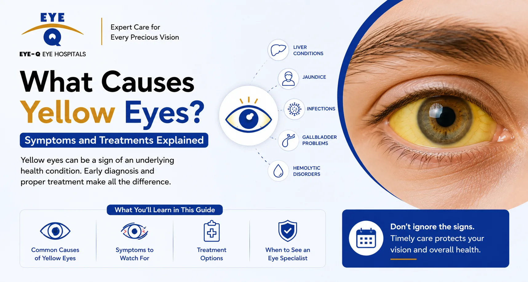 What Causes Yellow Eyes? Symptoms and Treatments Explained