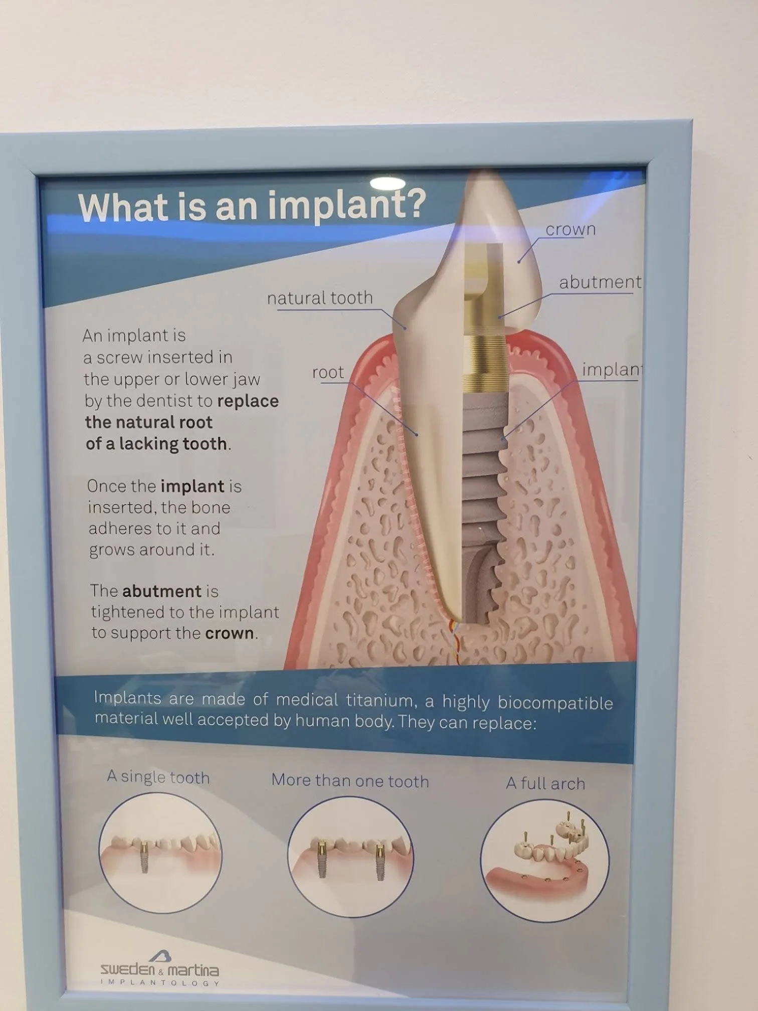 Dental Implants Coventry: The new method of replacing your smile.