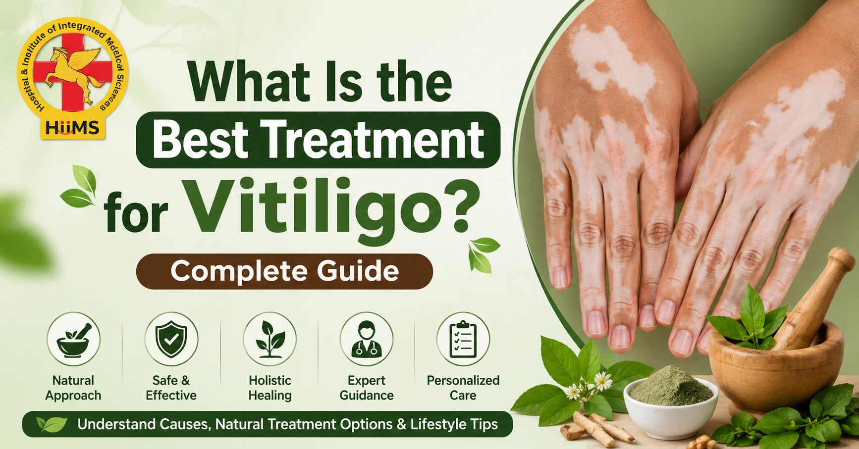 What Is the Best Treatment for Vitiligo? Complete Guide