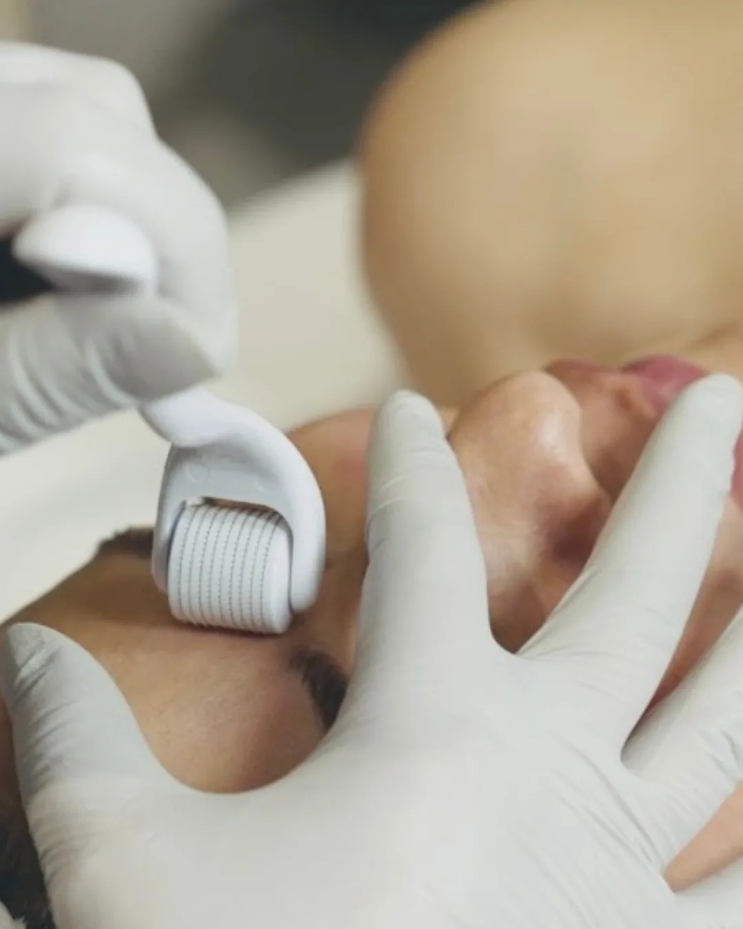 Why Microneedling Certification Is Important for Aesthetic Professionals