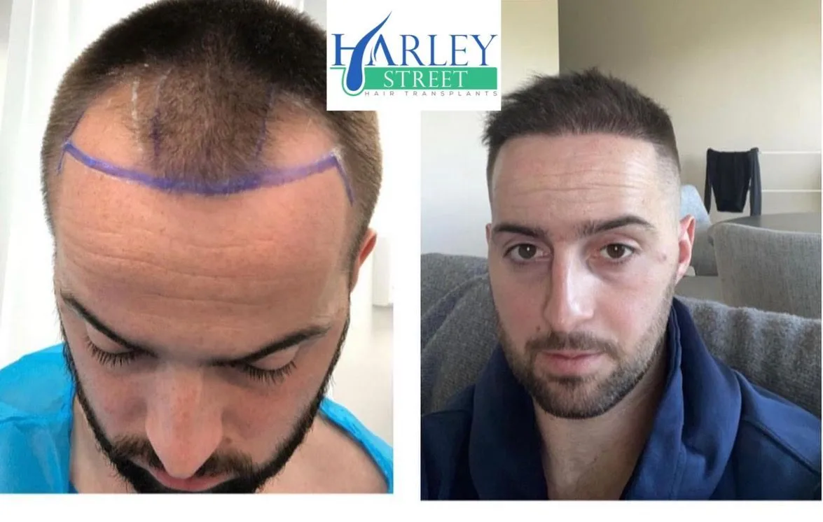Why Harley Street Hair Transplant Clinics Are the Gold Standard for Hair Restoration