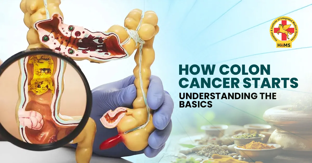What is Colon Cancer? A Simple Guide to Its Causes, Early Stages, and Risk Factors