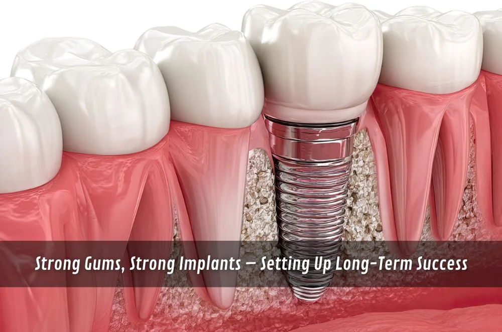 Strong Gums, Strong Implants – Setting Up Long-Term Success