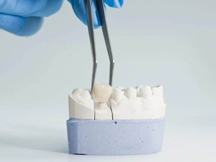9 Things Patients Often Don’t Know About Dental Crown Cost