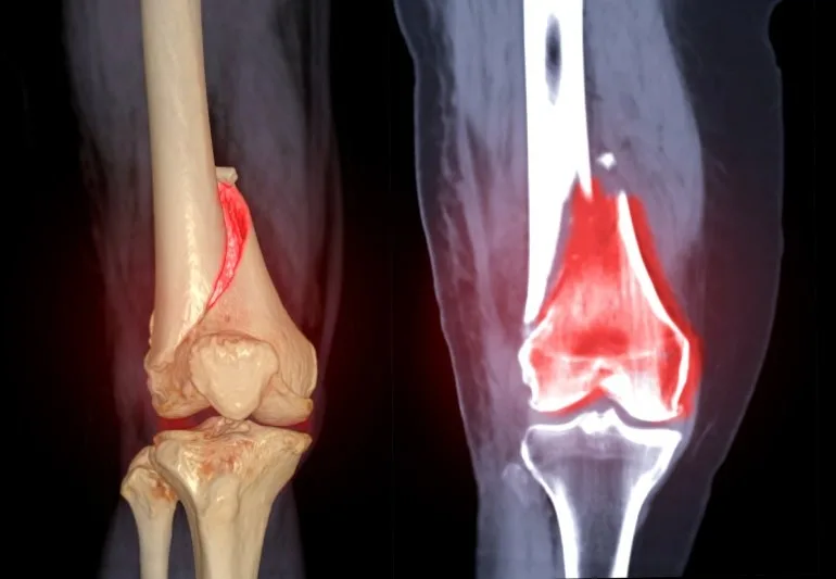 Live Better with a Joint Replacement Orthopedic Specialist