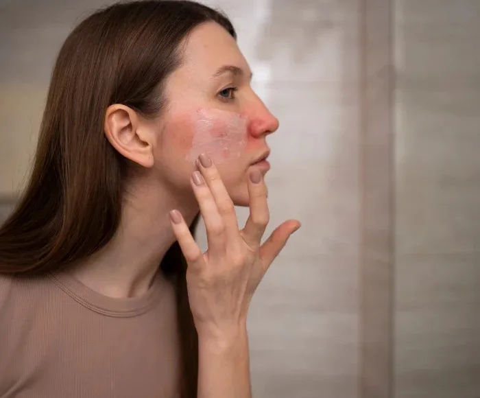 Which Acne Scar Treatment Is Best for Your Skin Type?