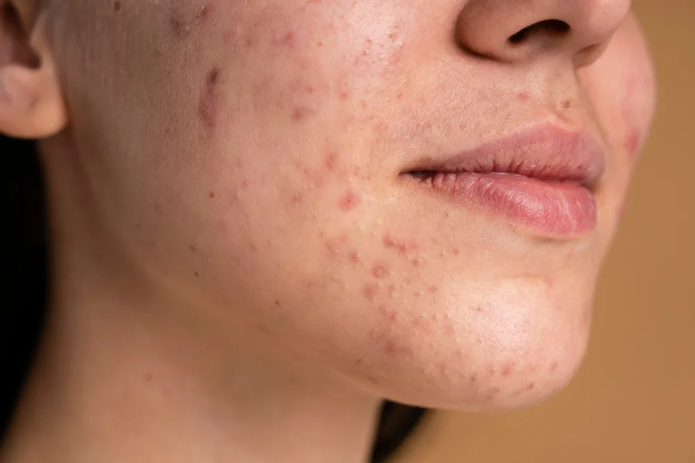 Acne Scar Treatment in Jayanagar: Complete Guide to Treatments, Cost & Recovery