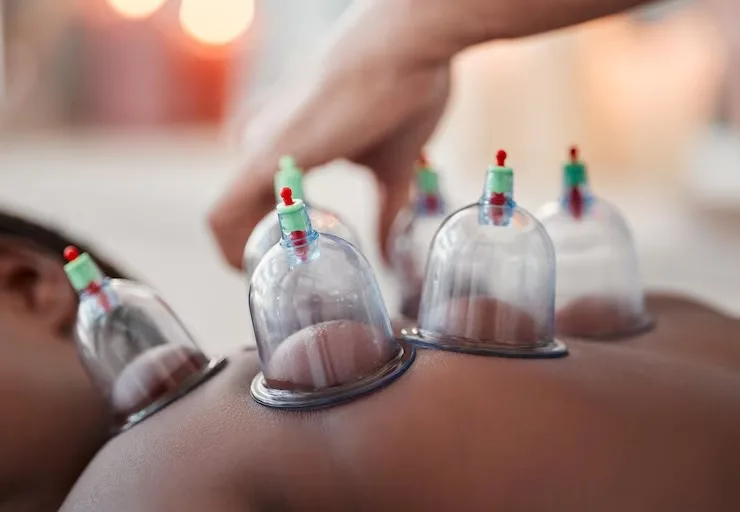 Does Cupping Therapy Help with Stress?