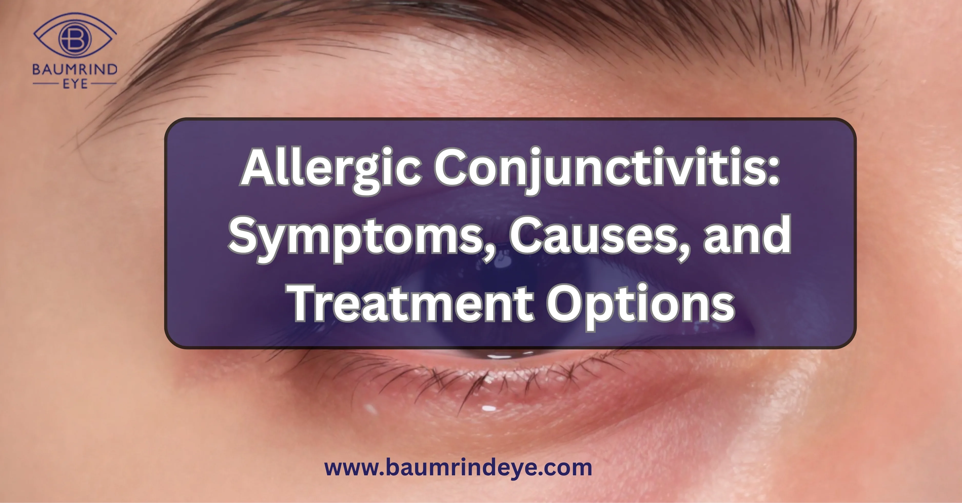 How to Treat Allergic Conjunctivitis: Symptoms, Causes & Expert Eye Care Solutions