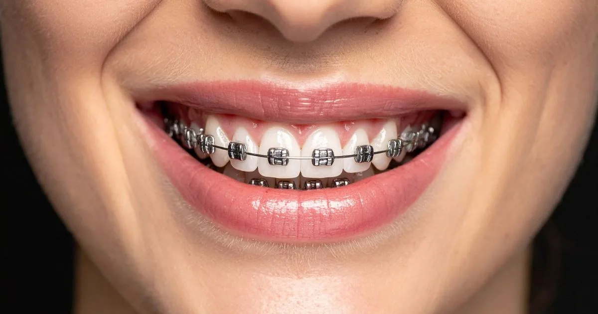 Best Braces Aligners Lahore – Clear Teeth Alignment Solutions