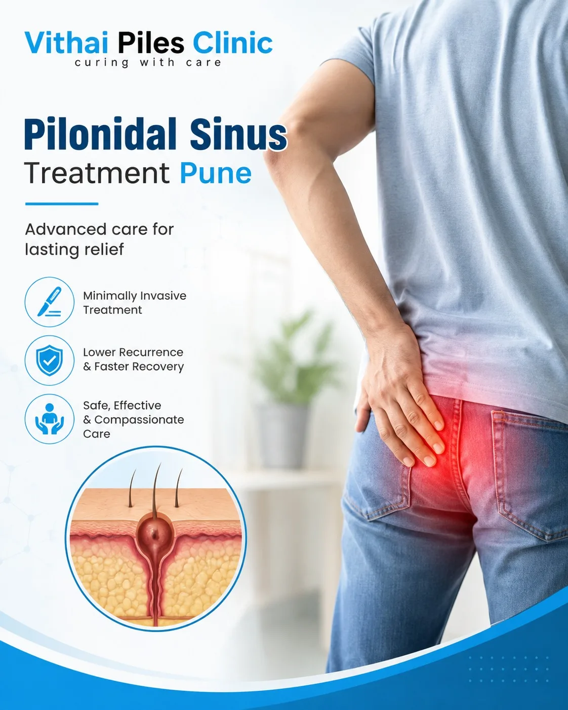 Pilonidal Sinus Surgery in Pune: A Complete Guide to Painless Recovery