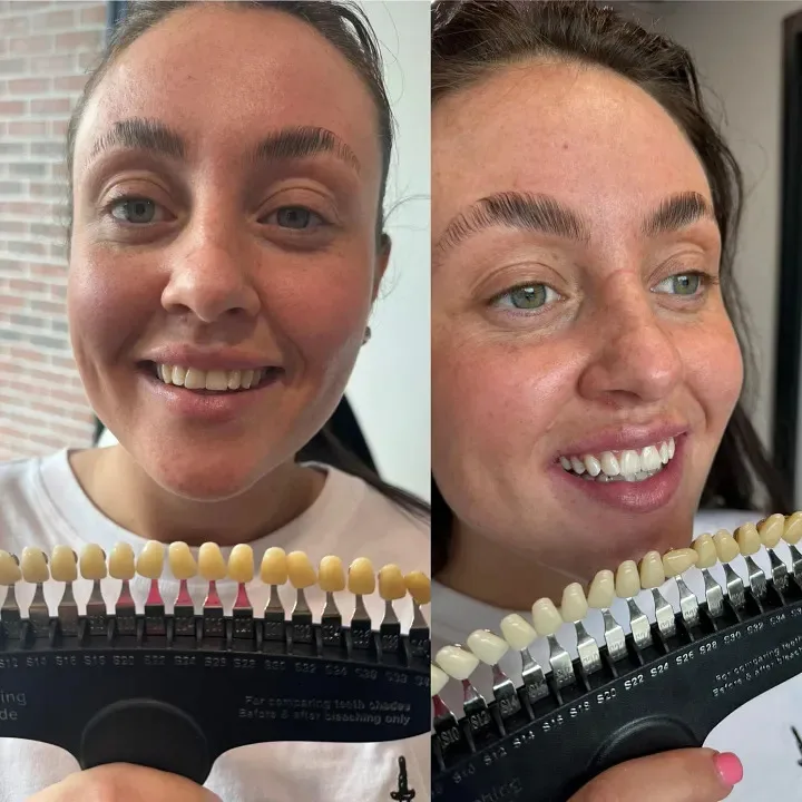 Teeth Whitening Dublin: Best Options, Costs & What Clinics Don’t Tell You