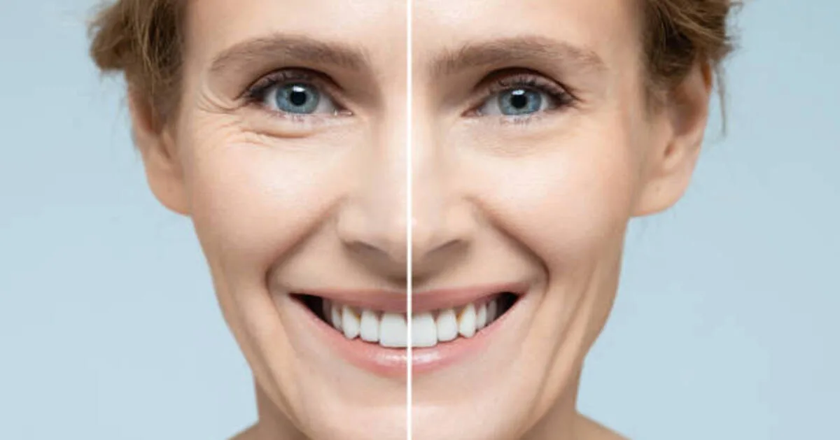 Surgical Face Lift and Long-Term Facial Rejuvenation