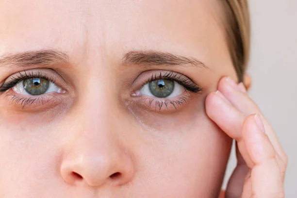 Under Eye Treatment Dubai: Understanding the Delicate Eye Area