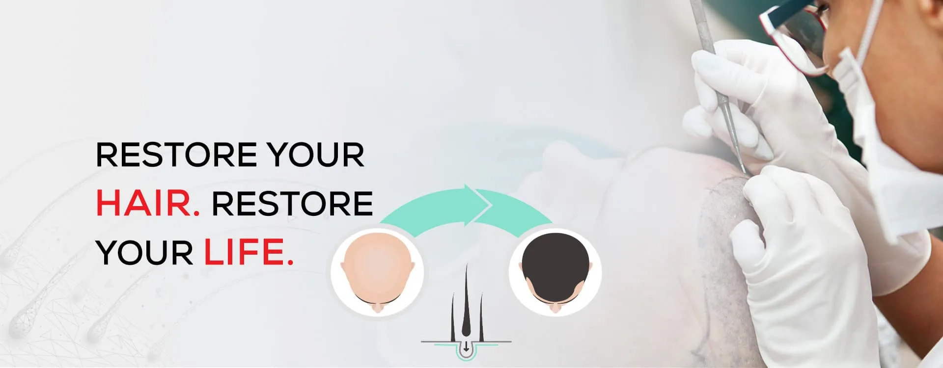 Hair Transplant Cost in Rajkot – What You Should Know Before Choosing Treatment