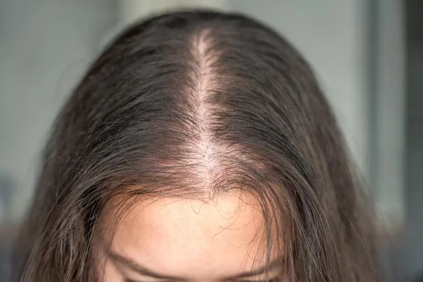 What to Do When Your Current Hair Loss Treatment for Women Is Not Delivering Results