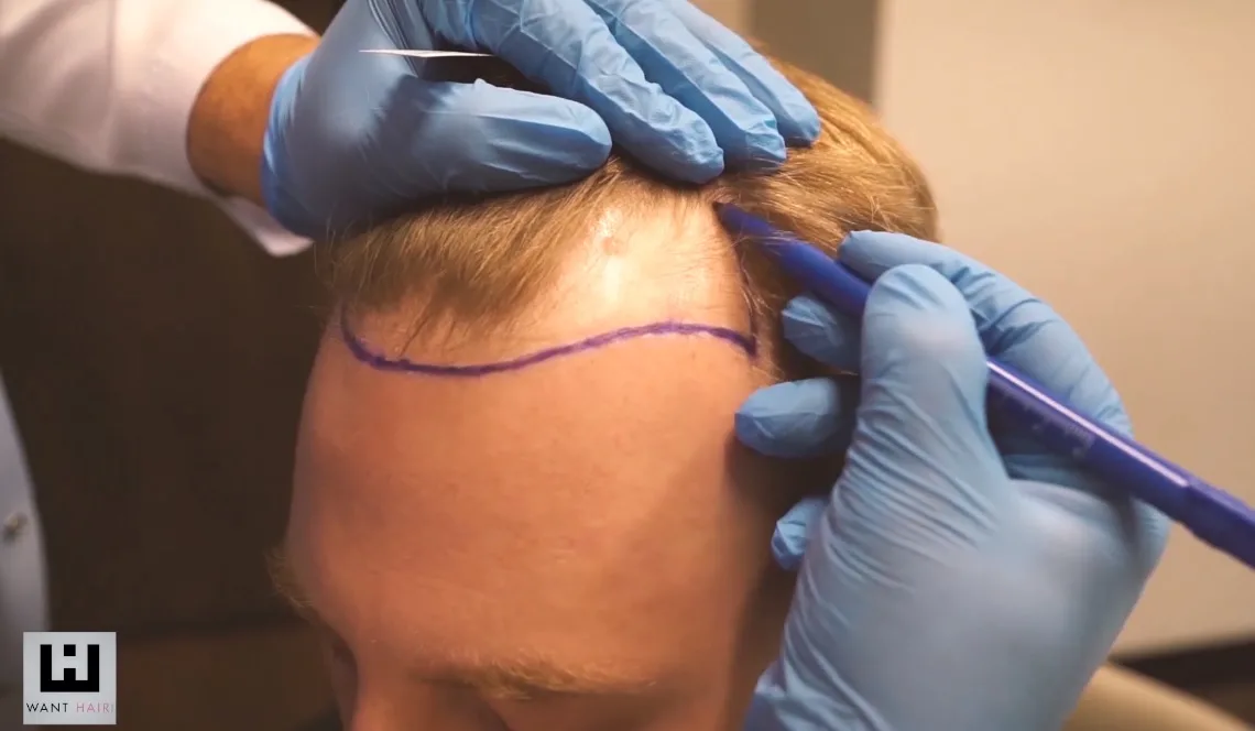 Find the Right Hair Transplant in Turkey Package for Your Restoration Journey
