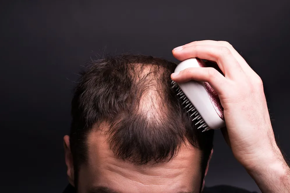 Reliable Alopecia Treatment UK by Experienced Hair Specialists