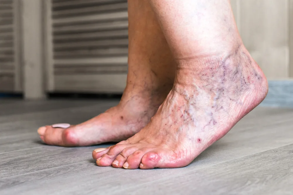 How Venous Insufficiency Affects Your Feet: When to See a Podiatrist